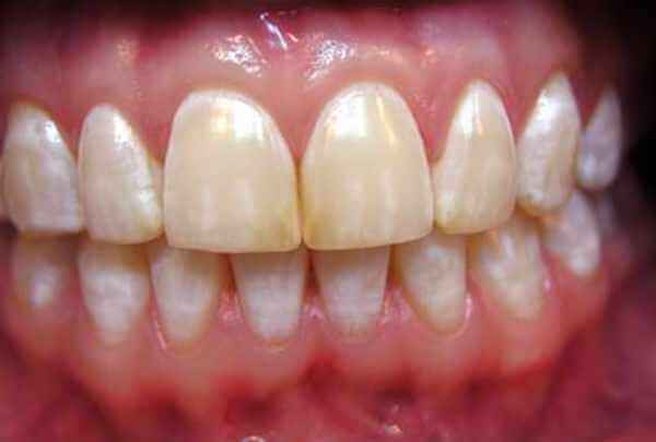 симптоматика белых пятен на зубах